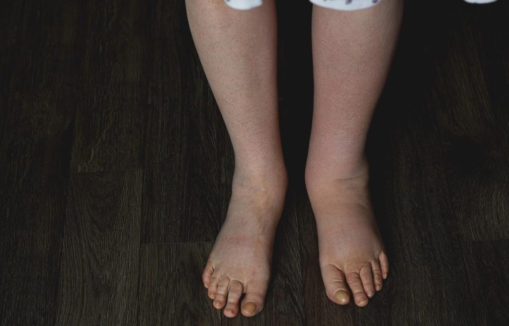 Female-legs-and-feet-with-lymphedema-condition-Sarasota-Florida-Functional-Transformation-Clinic